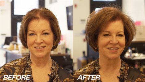Before and After Hair Thinning Treatment In NYC